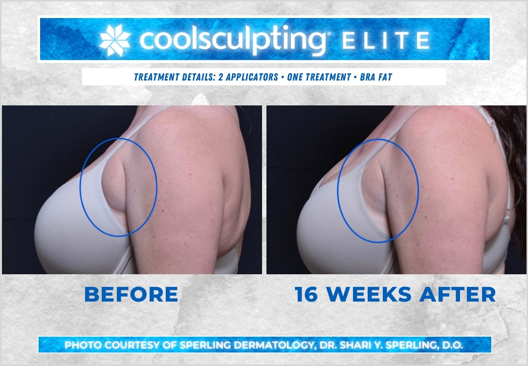 Before & After Axillary Puffs CoolSculpting in New Jersey
