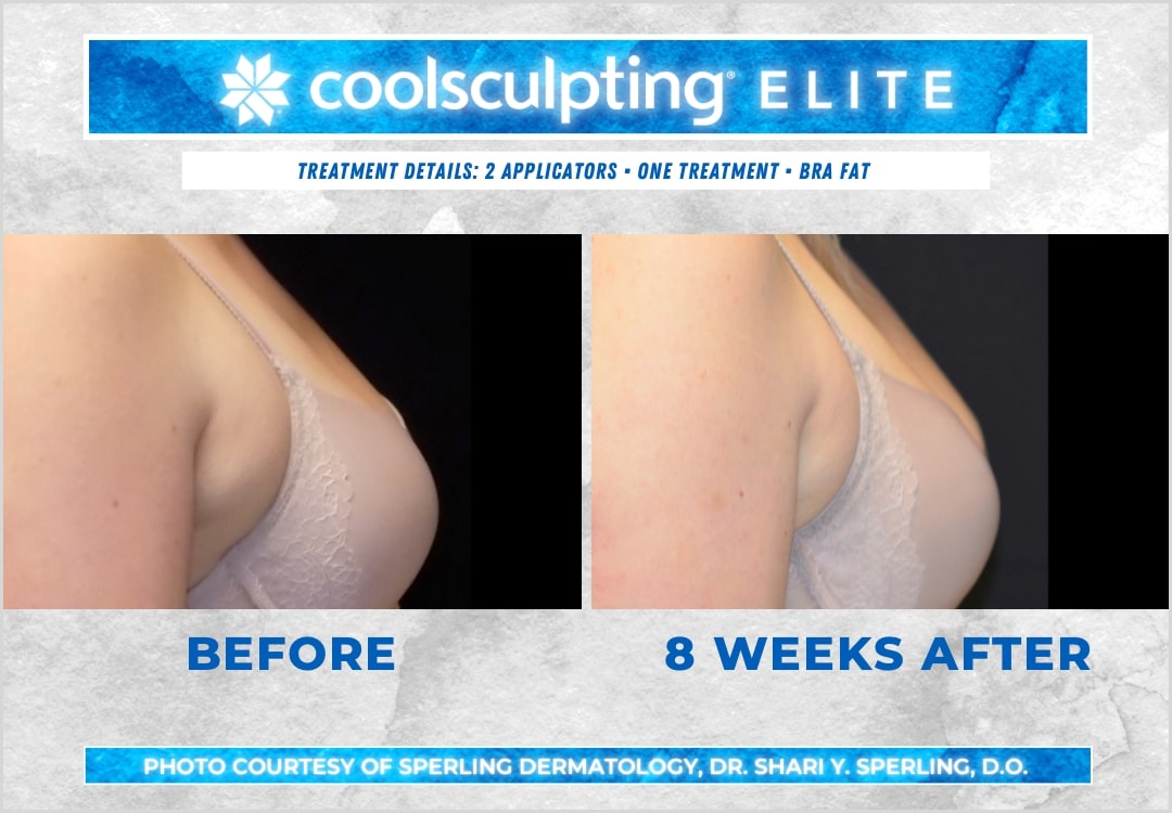 Before & After Axillary Puffs CoolSculpting in New Jersey