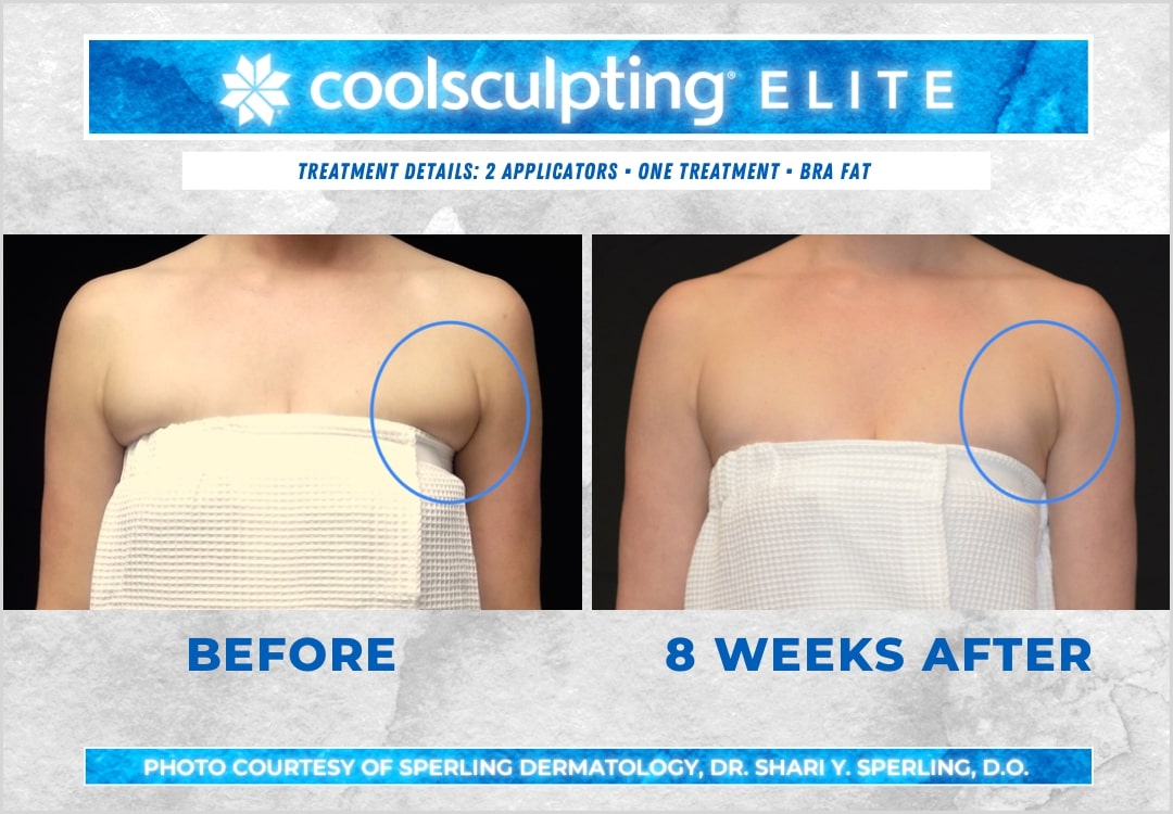 Before & After Axillary Puffs CoolSculpting in New Jersey