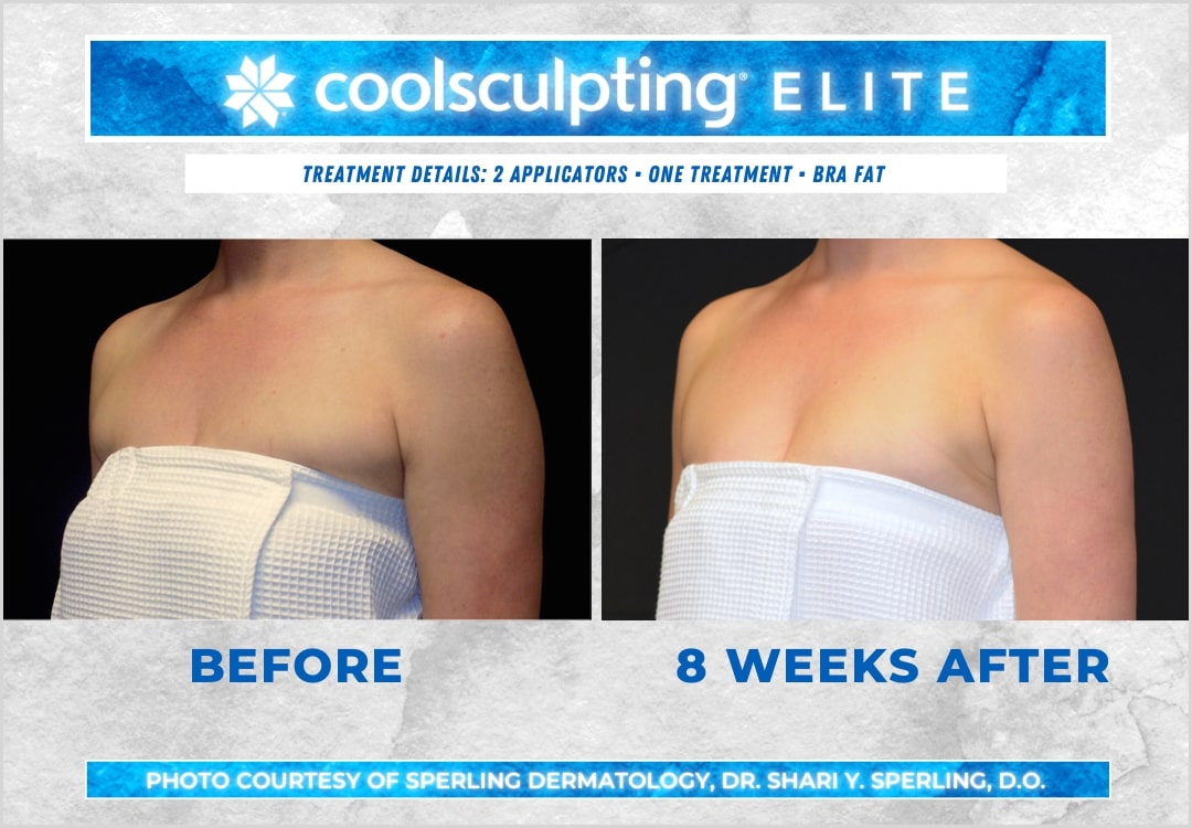 Before & After Axillary Puffs CoolSculpting in New Jersey