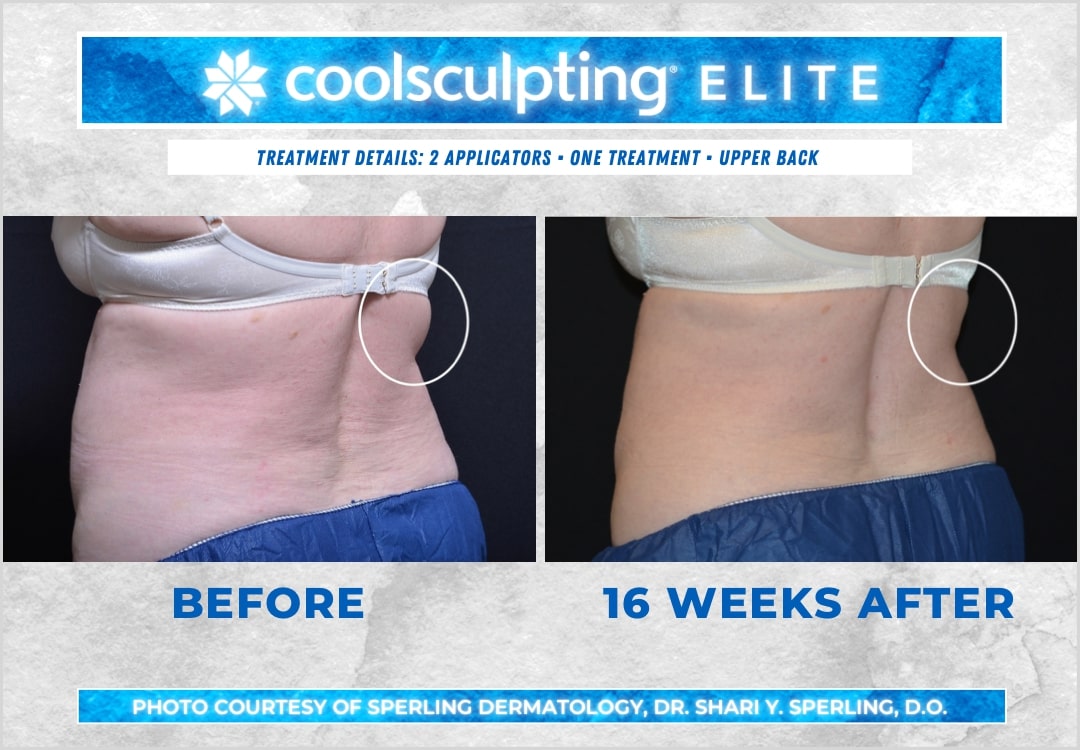 Before & After Bra line CoolSculpting in New Jersey