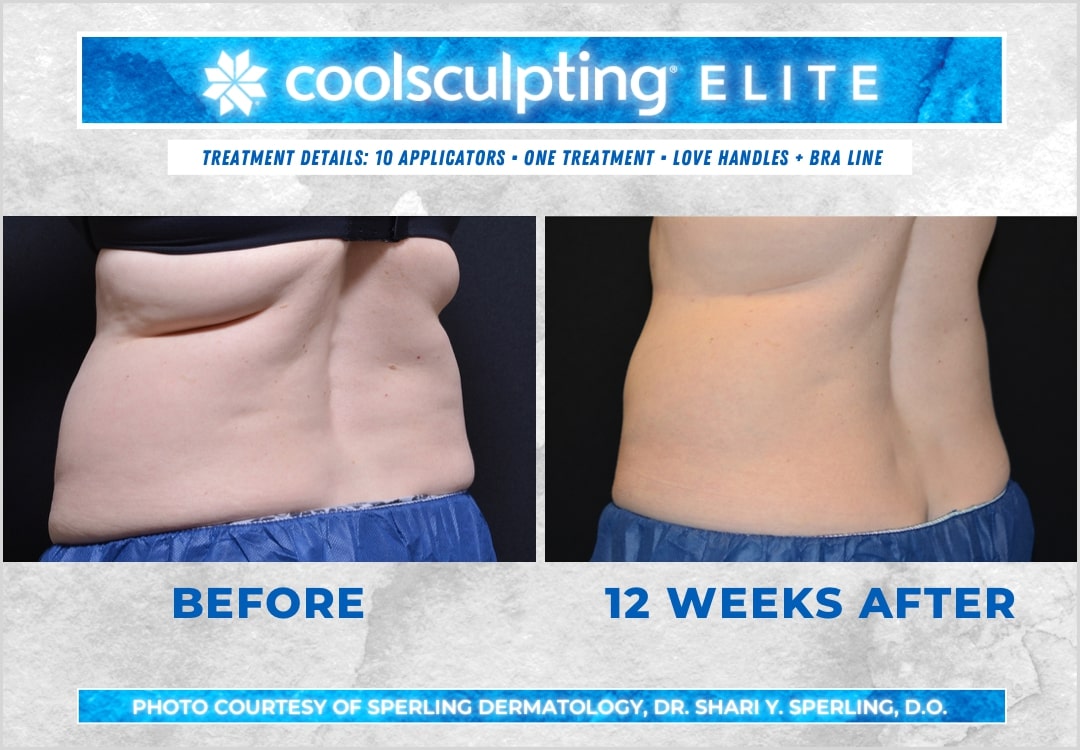 Before & After Bra line CoolSculpting in New Jersey