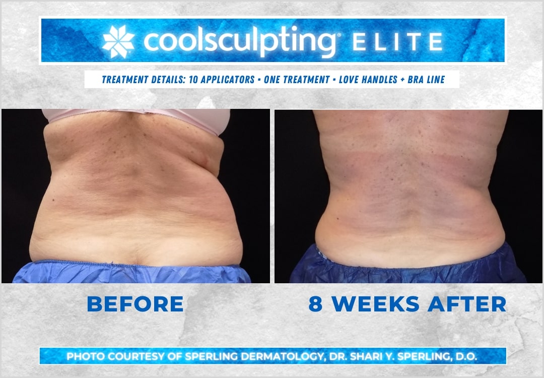 Before & After Bra line CoolSculpting in New Jersey