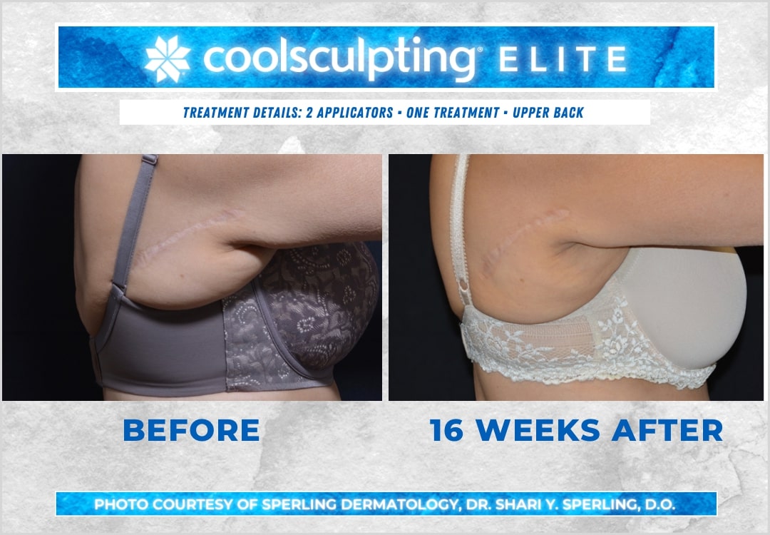 Before & After Bra line CoolSculpting in New Jersey