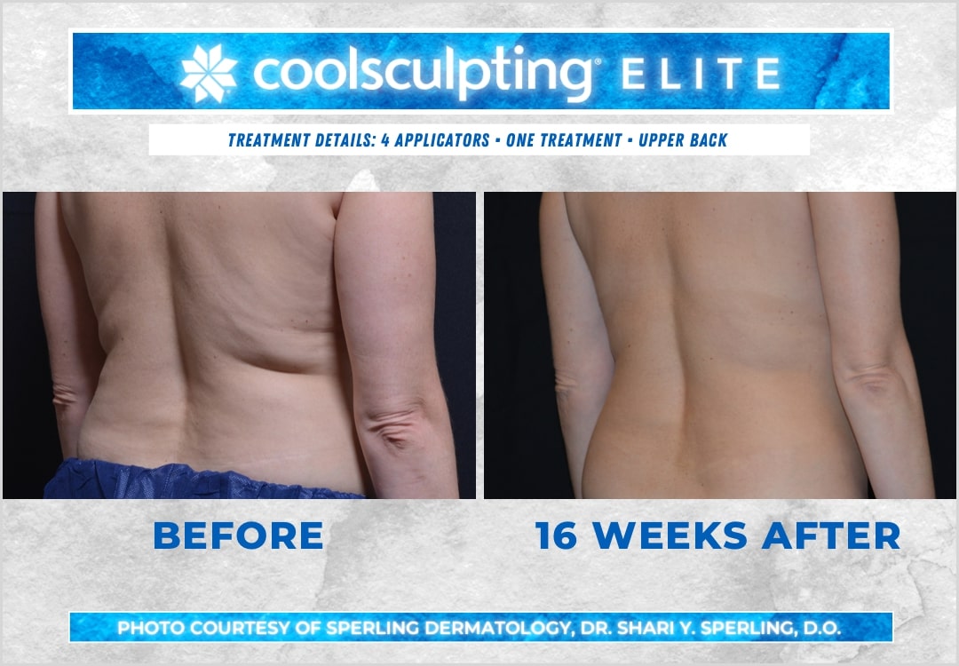 Before & After Bra line CoolSculpting in New Jersey