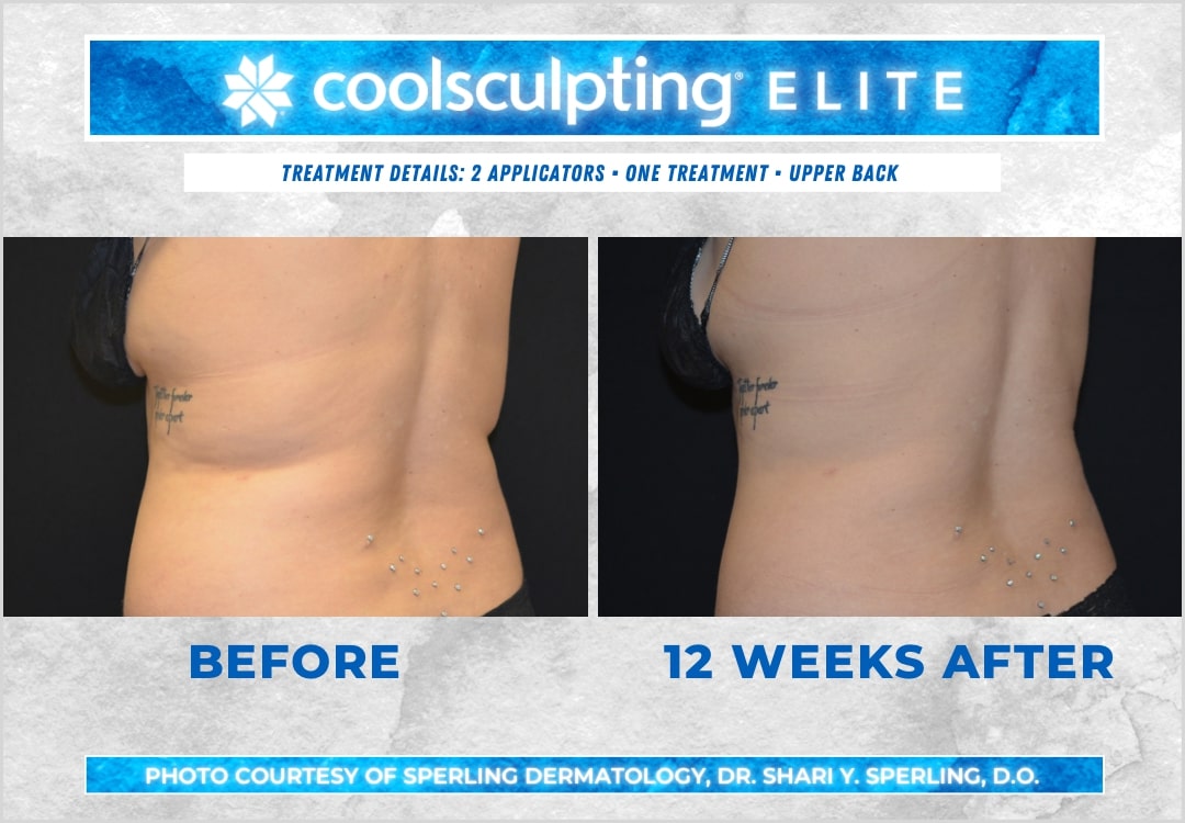 Before & After Bra line CoolSculpting in New Jersey