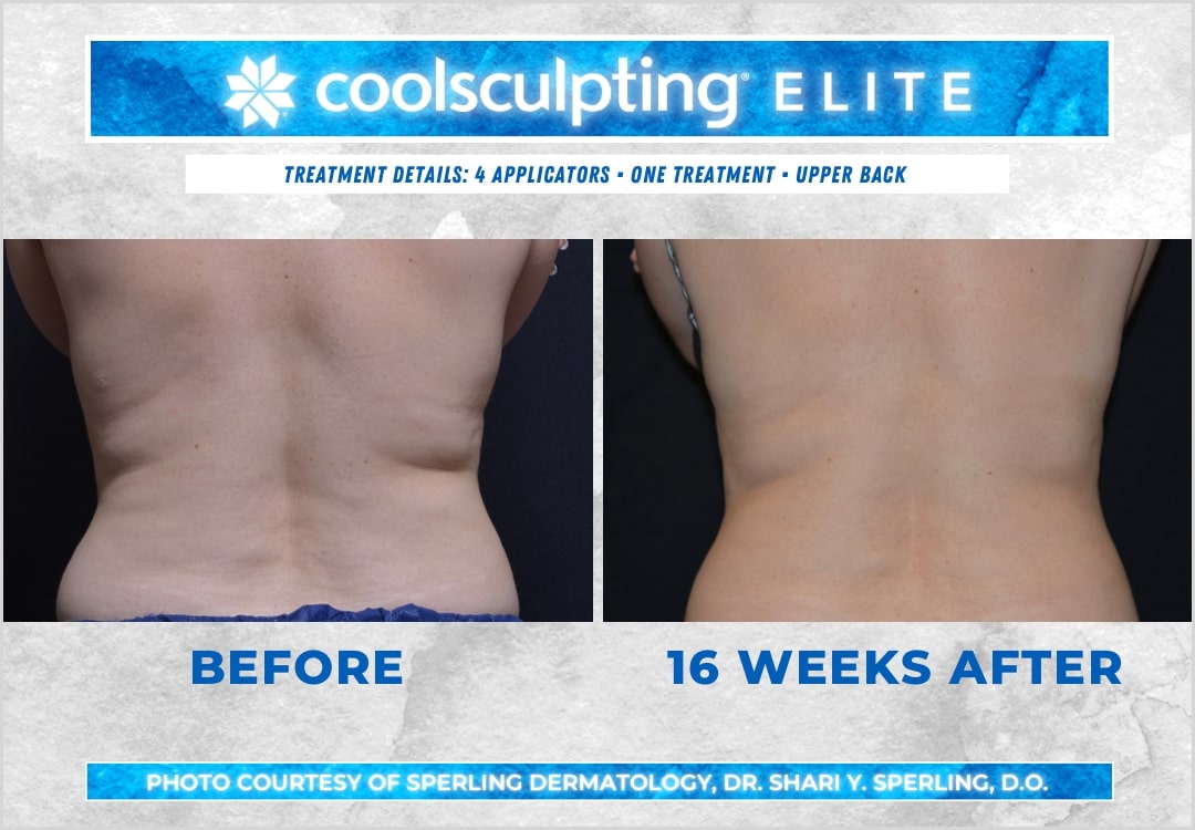 Before & After Bra line CoolSculpting in New Jersey