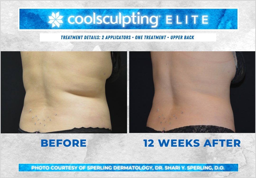 Before & After Bra line CoolSculpting in New Jersey