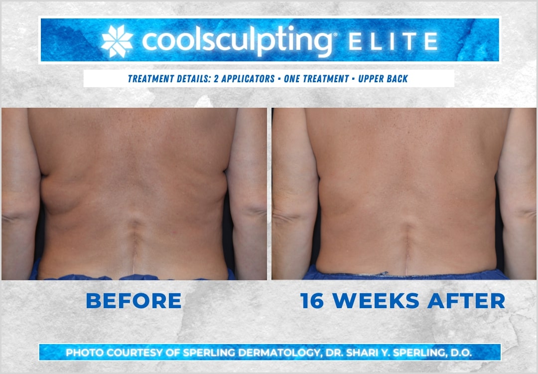 Before & After Bra line CoolSculpting in New Jersey