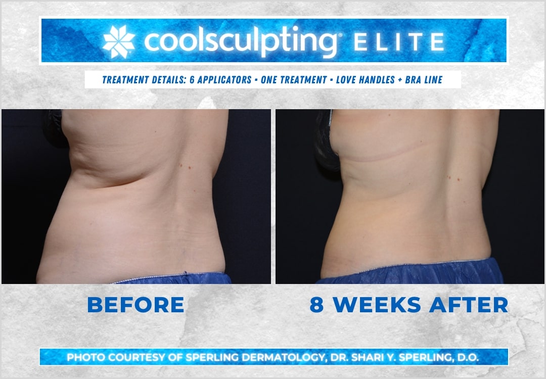 Before & After Bra line CoolSculpting in New Jersey