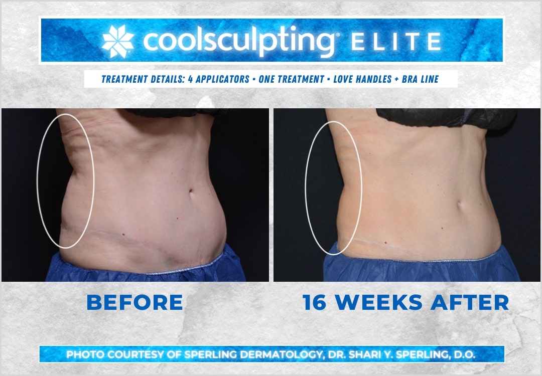 Before & After Bra line CoolSculpting in New Jersey