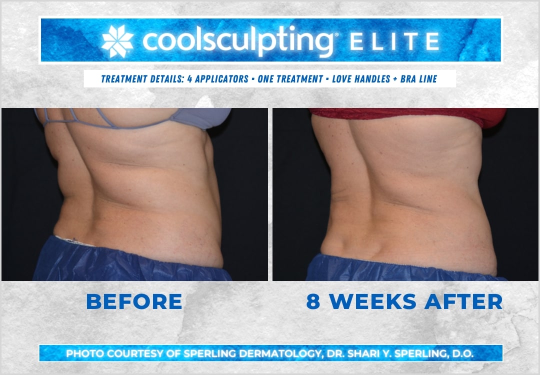 Before & After Bra line CoolSculpting in New Jersey