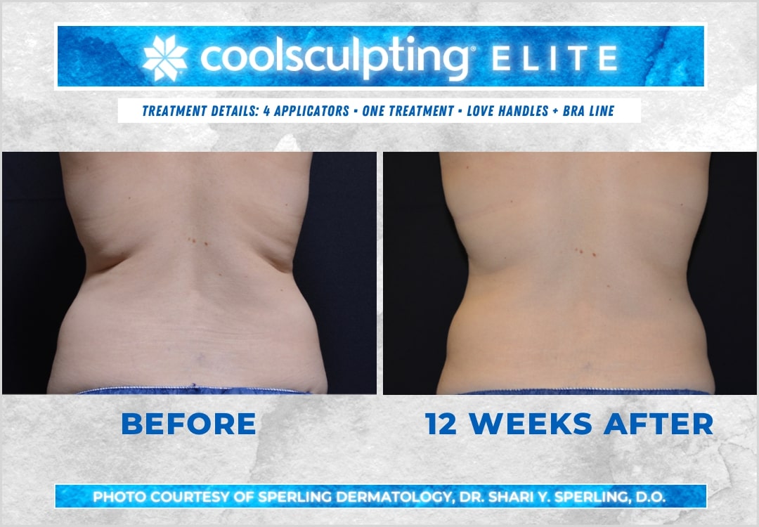 Before & After Bra line CoolSculpting in New Jersey