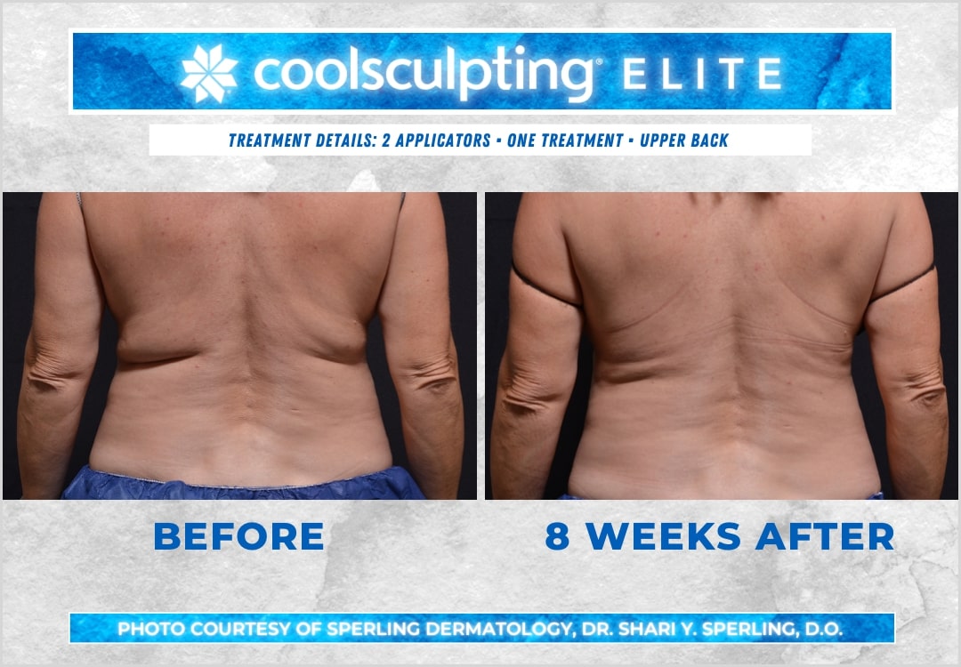 Before & After Bra line CoolSculpting in New Jersey