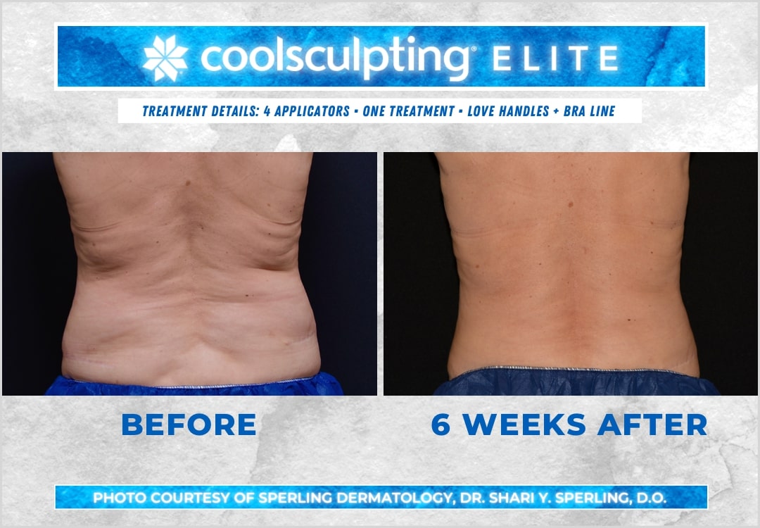 Before & After Bra line CoolSculpting in New Jersey