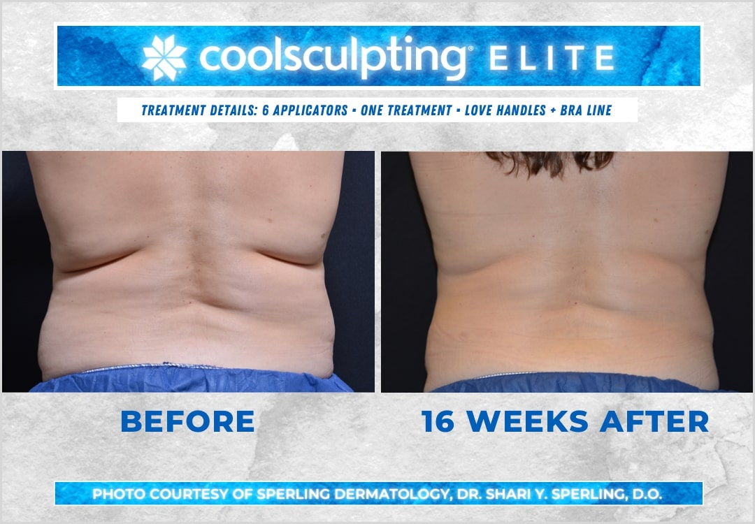 Bra line CoolSculpting Before & After Patient 06