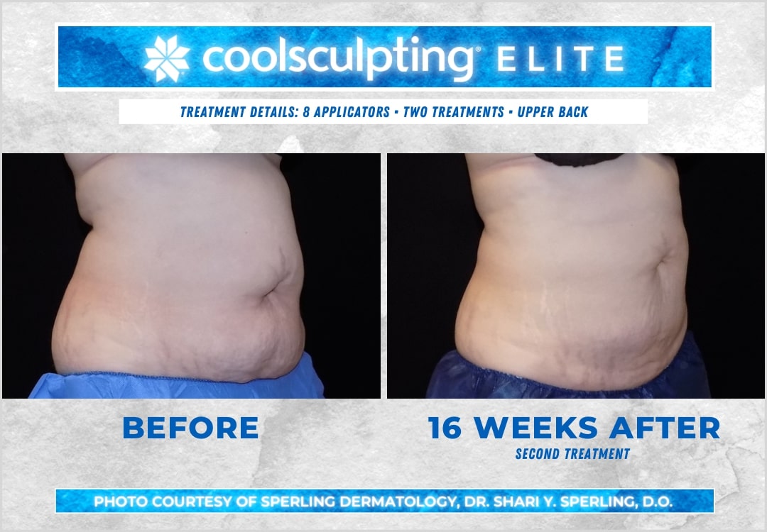 Before & After Bra line CoolSculpting in New Jersey