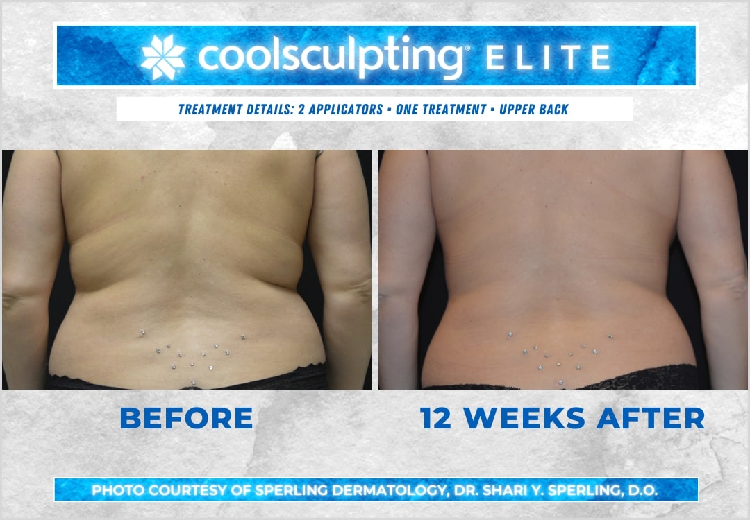 Before & After Bra line CoolSculpting in New Jersey