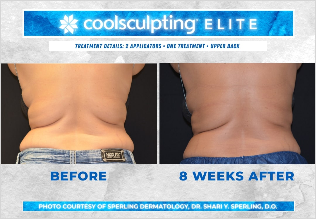 Before & After Bra line CoolSculpting in New Jersey