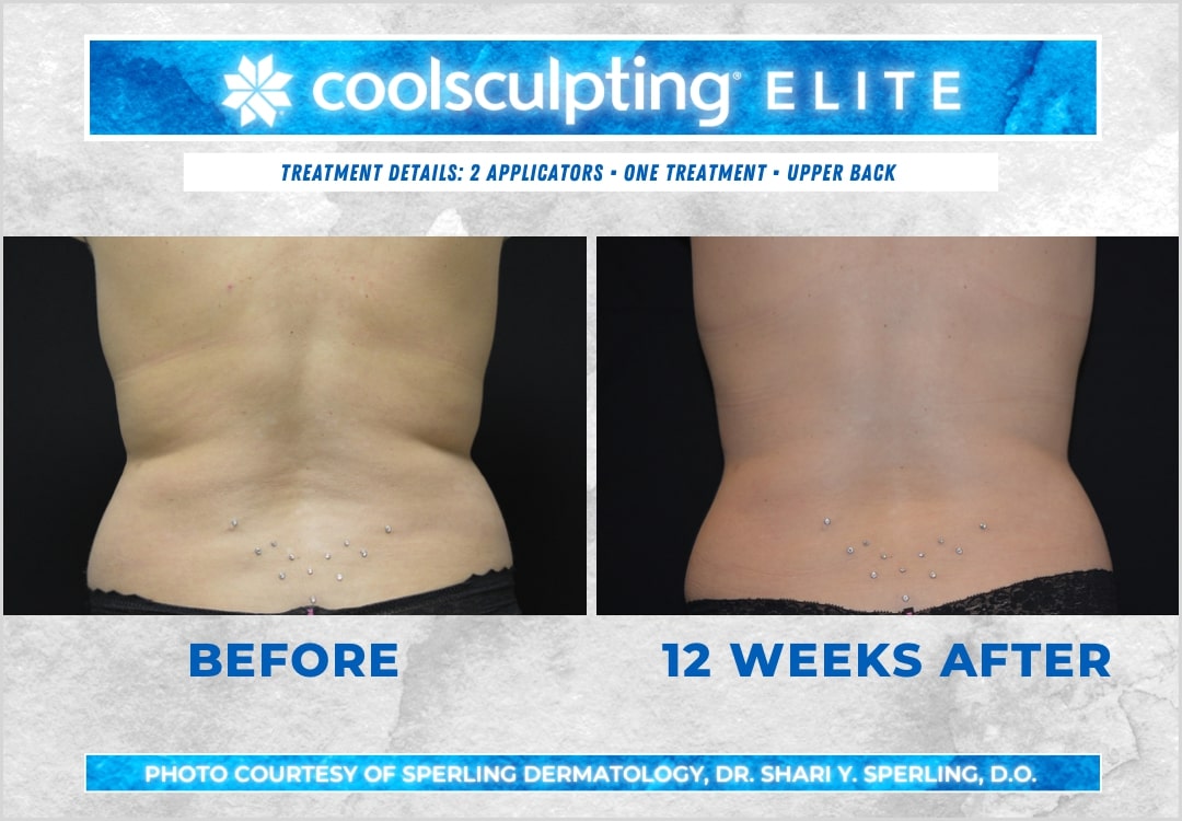 Before & After Bra line CoolSculpting in New Jersey