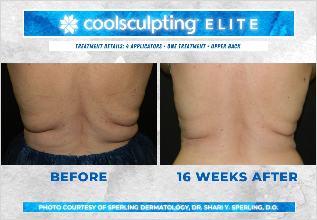 Before & After Bra line CoolSculpting in New Jersey