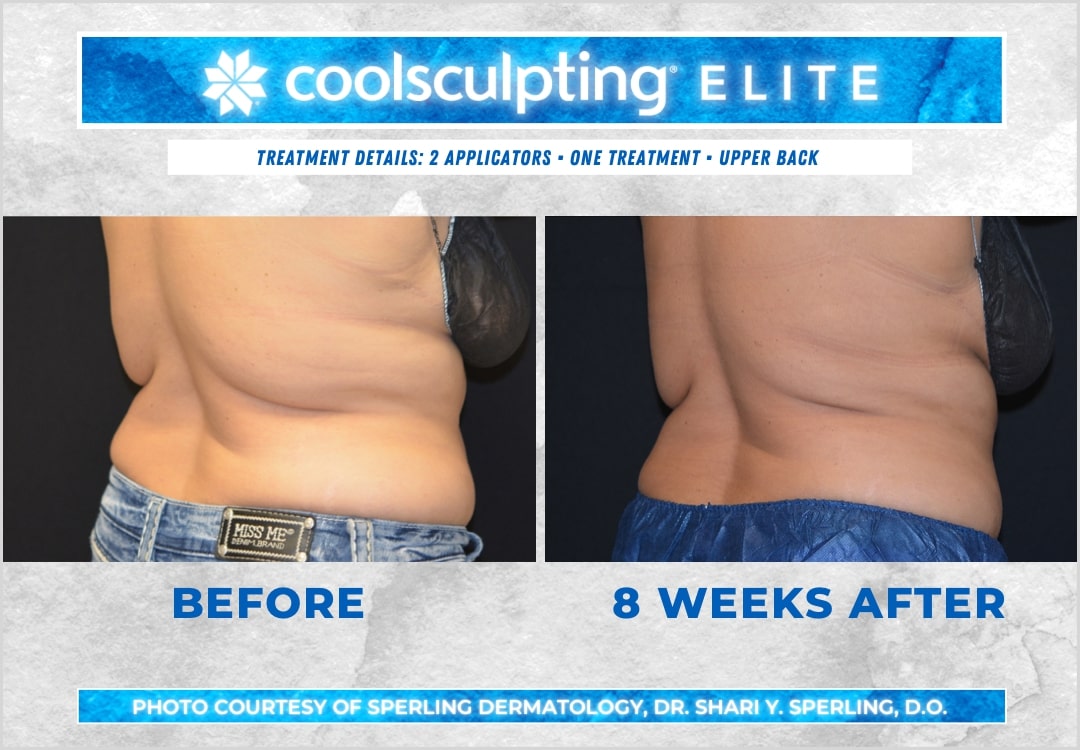 Before & After Bra line CoolSculpting in New Jersey