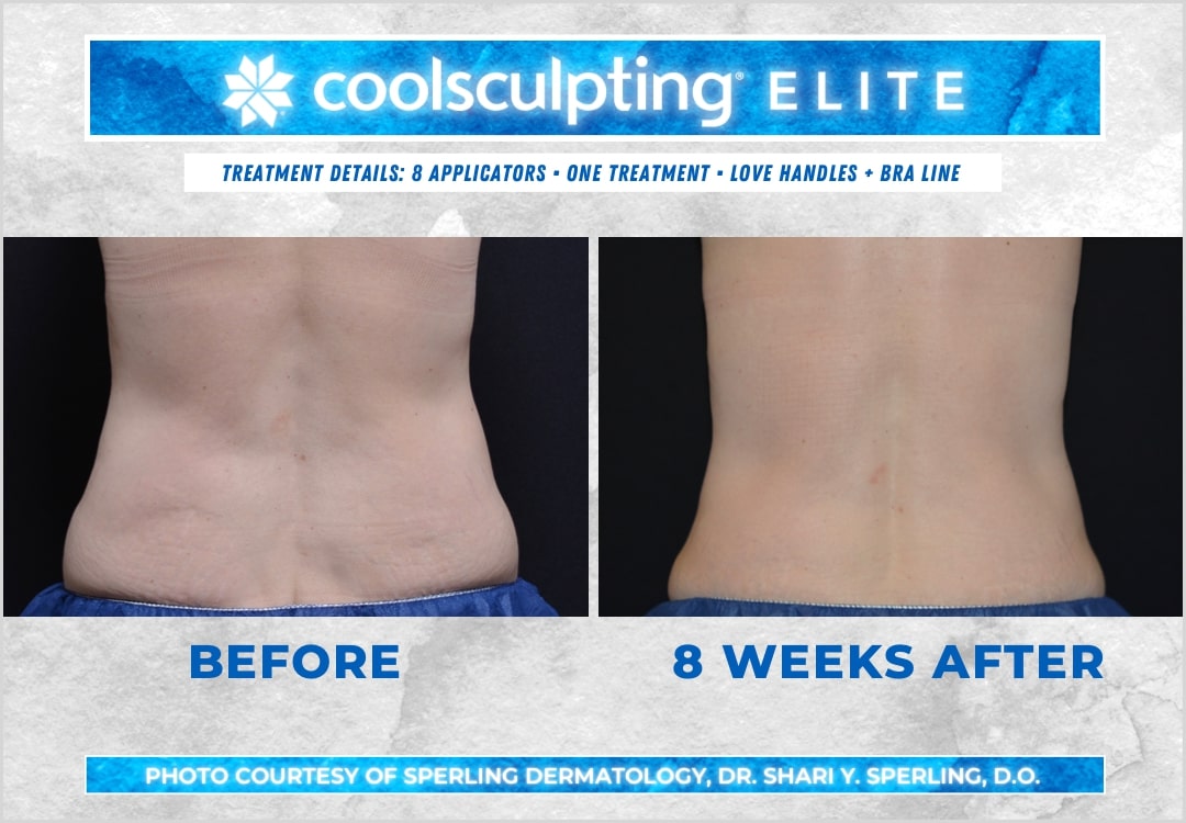 Before & After Bra line CoolSculpting in New Jersey