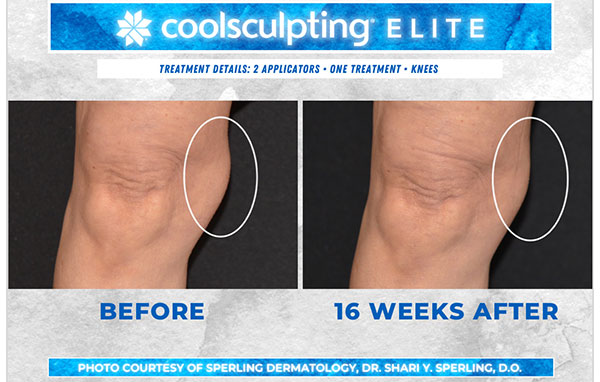 Before & After Knees CoolSculpting in New Jersey