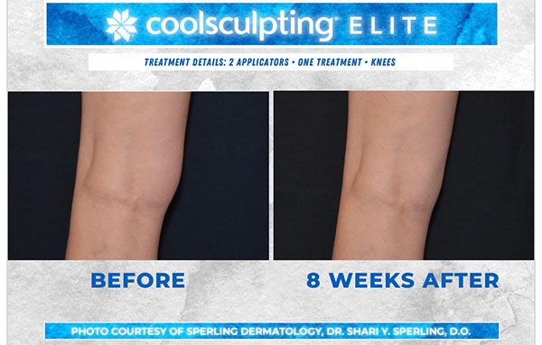 Before & After Knees CoolSculpting in New Jersey