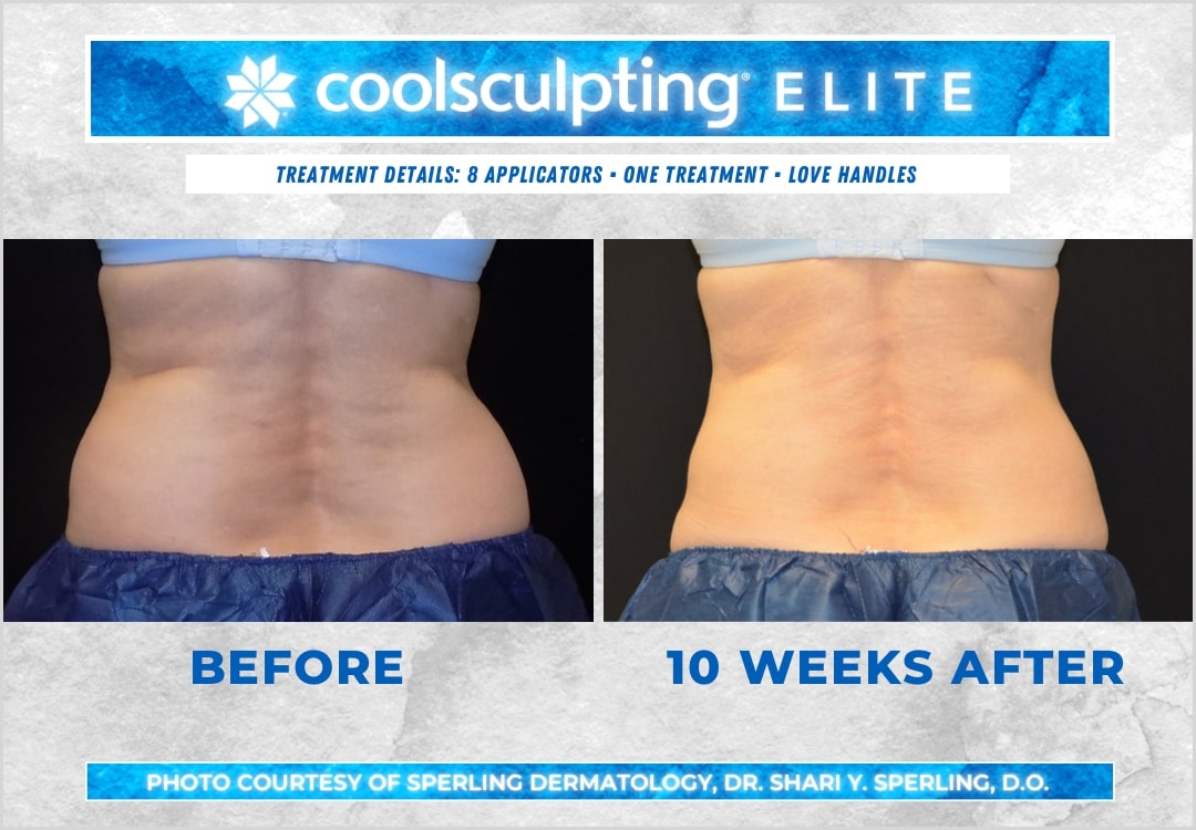 Before & After Love Handles CoolSculpting in New Jersey