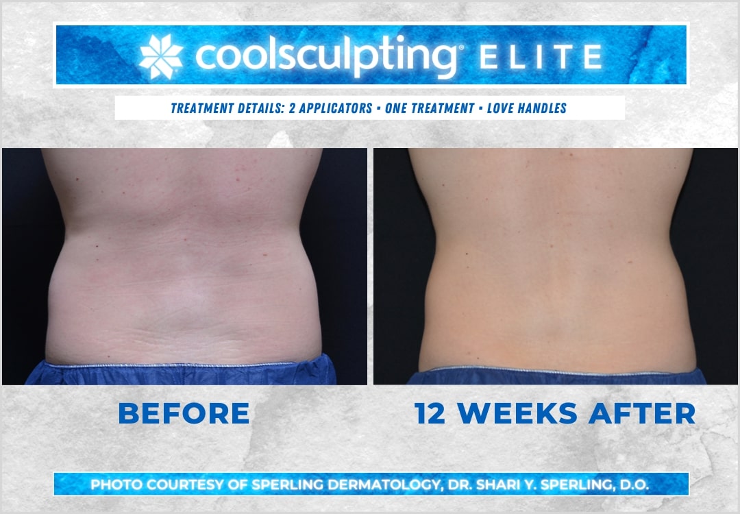 Before & After Love Handles CoolSculpting in New Jersey