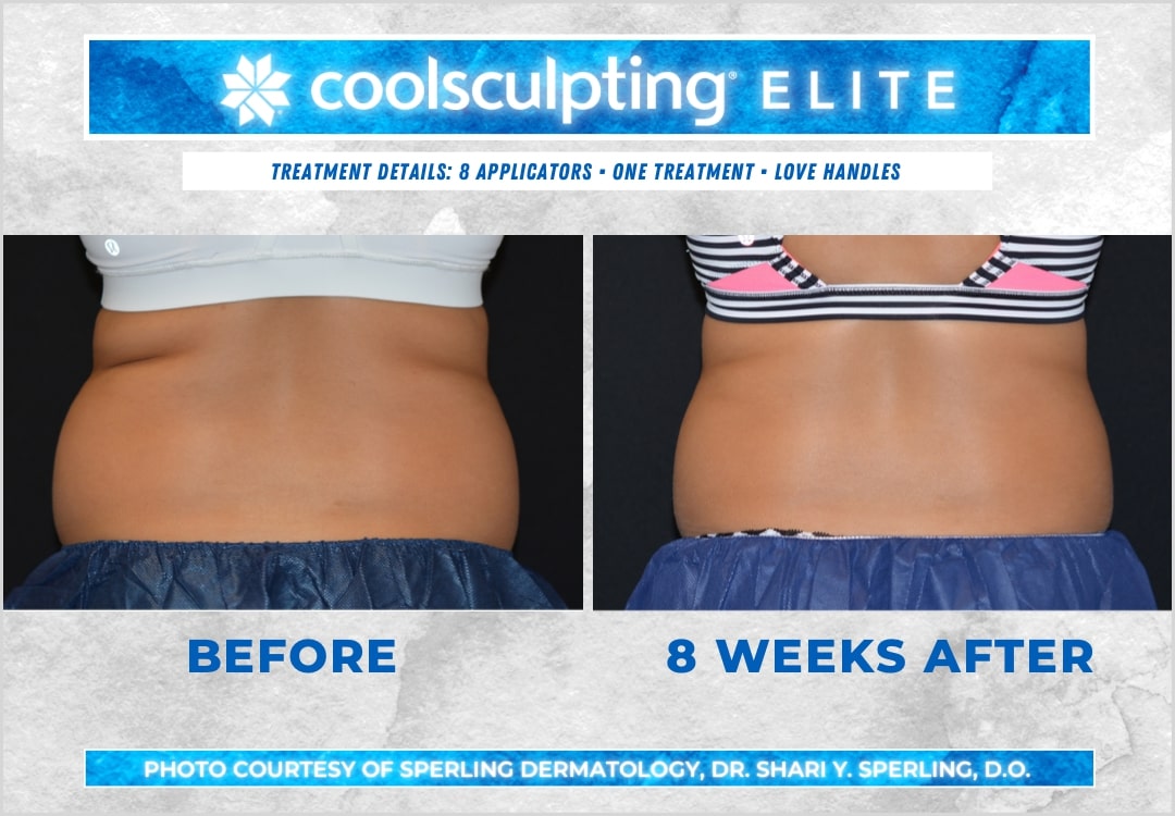 Before & After Love Handles CoolSculpting in New Jersey