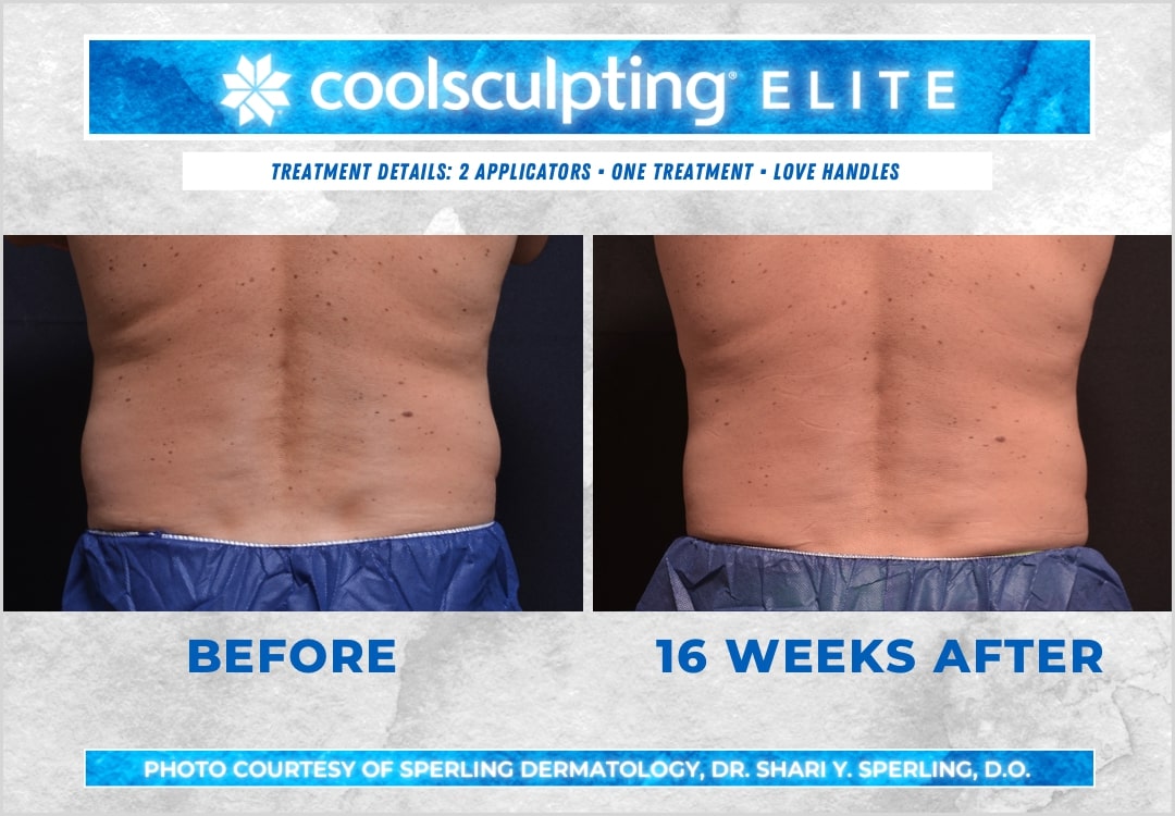 Before & After Love Handles CoolSculpting in New Jersey