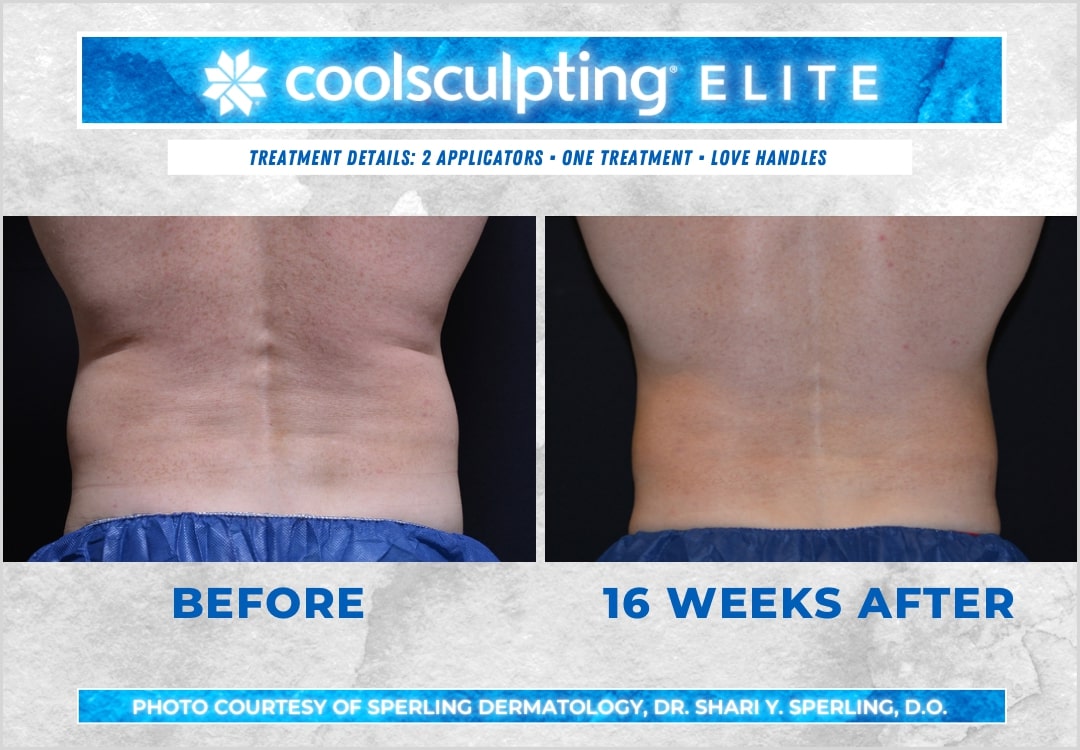 Before & After Love Handles CoolSculpting in New Jersey