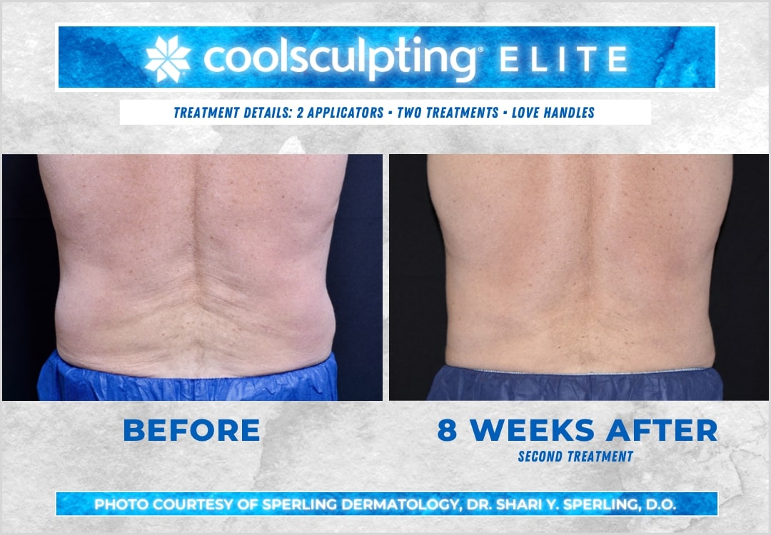 Before & After Love Handles CoolSculpting in New Jersey