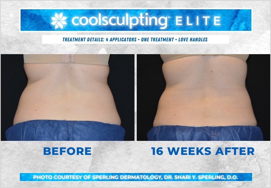 Before & After Love Handles CoolSculpting in New Jersey