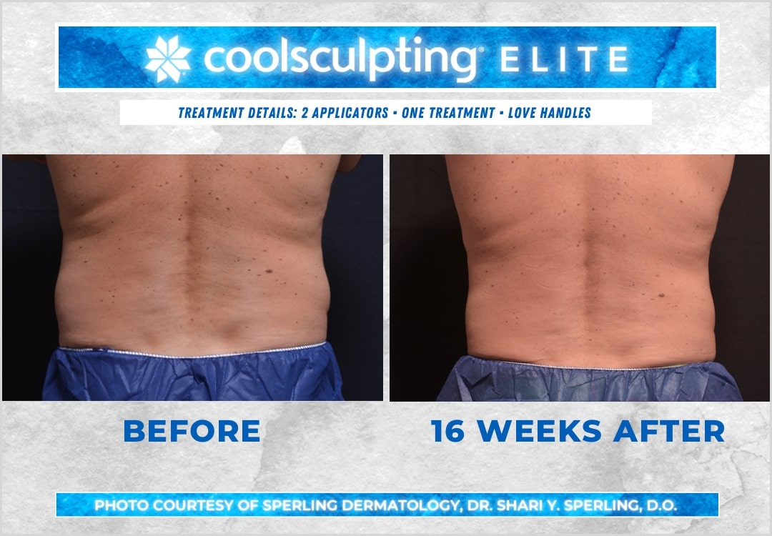 Before & After Love Handles CoolSculpting in New Jersey