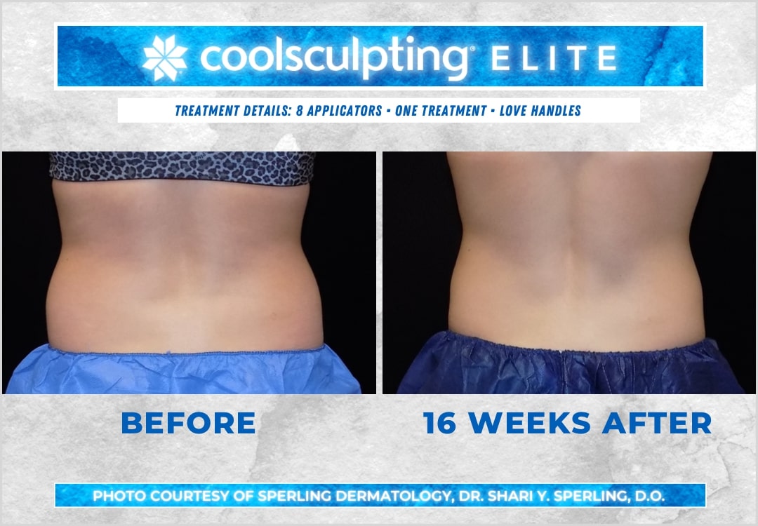 Before & After Love Handles CoolSculpting in New Jersey