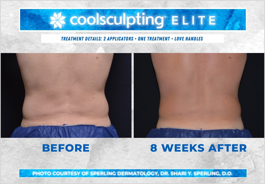 Before & After Love Handles CoolSculpting in New Jersey