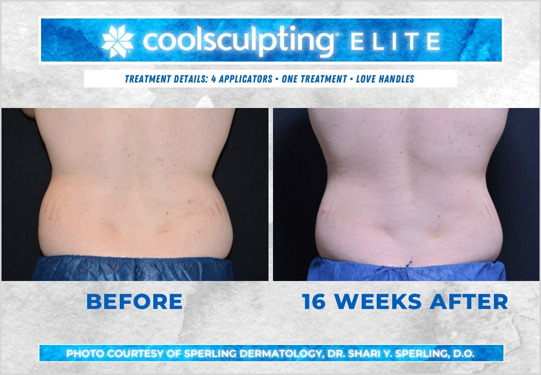 Before & After Love Handles CoolSculpting in New Jersey