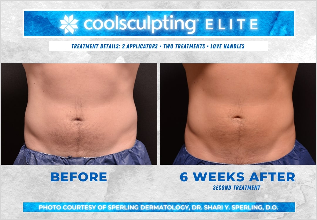 Before & After Love Handles CoolSculpting in New Jersey