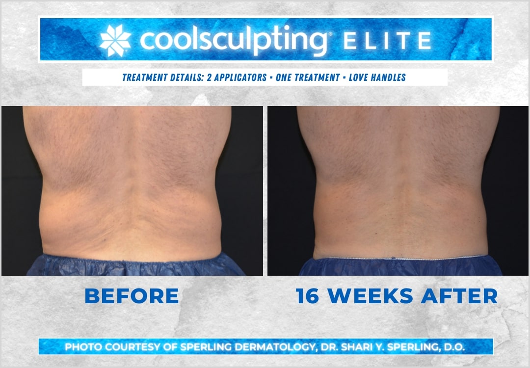 Before & After Love Handles CoolSculpting in New Jersey