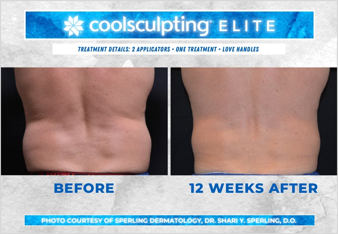 Before & After Love Handles CoolSculpting in New Jersey