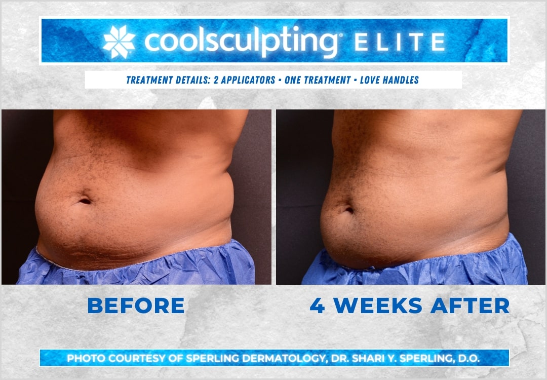 Before & After Love Handles CoolSculpting in New Jersey