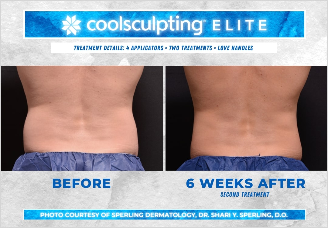 Before & After Love Handles CoolSculpting in New Jersey