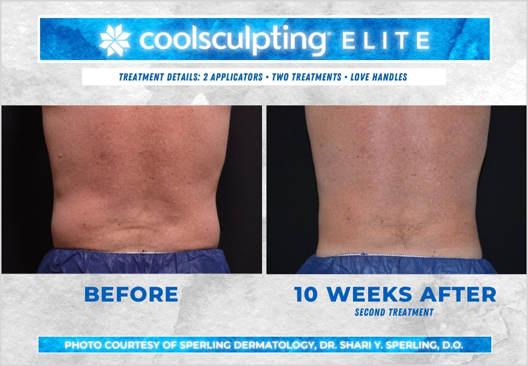 Before & After Love Handles CoolSculpting in New Jersey