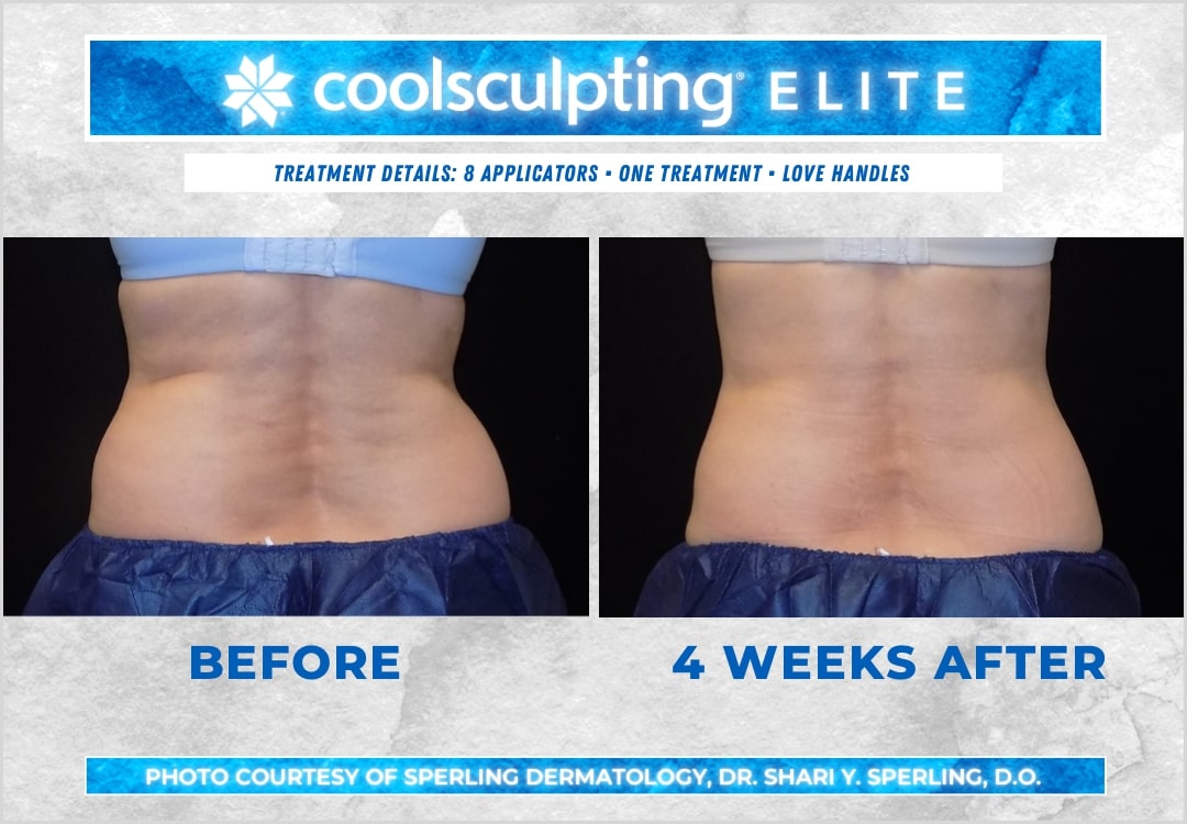 Before & After Love Handles CoolSculpting in New Jersey