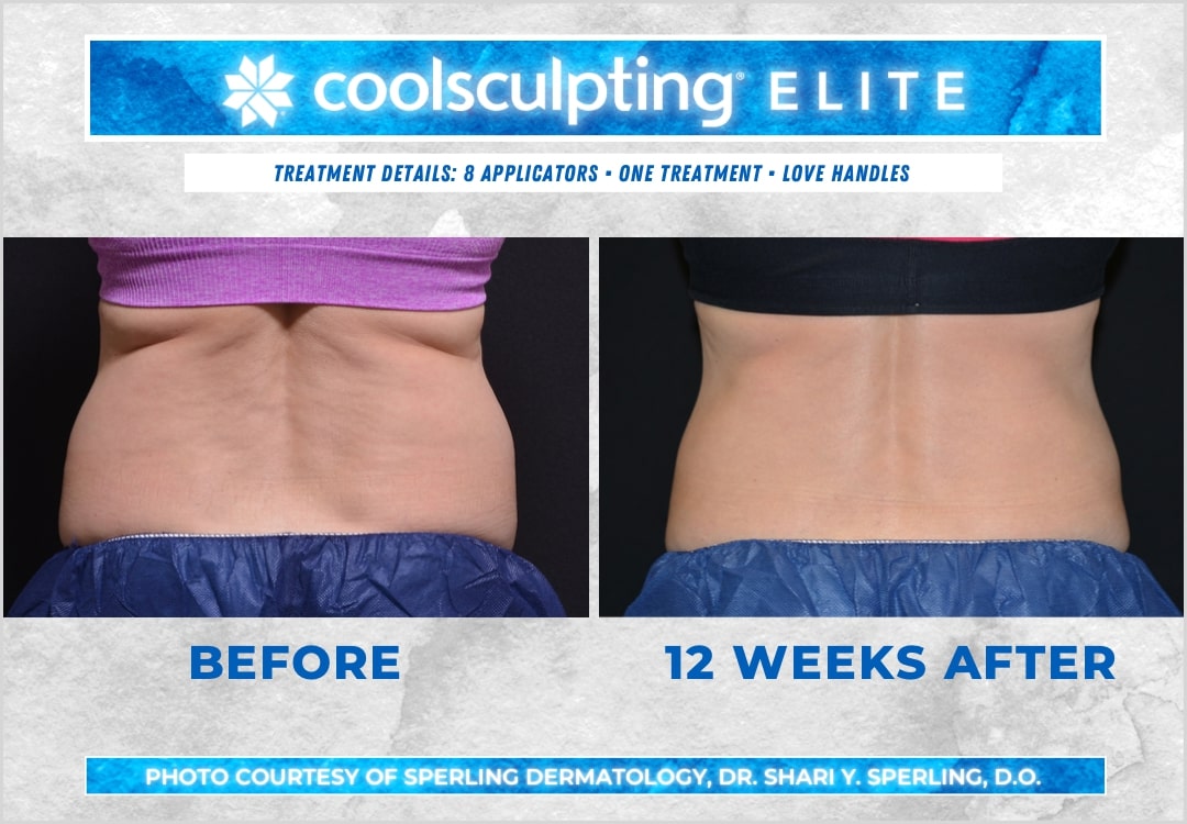 Before & After Love Handles CoolSculpting in New Jersey