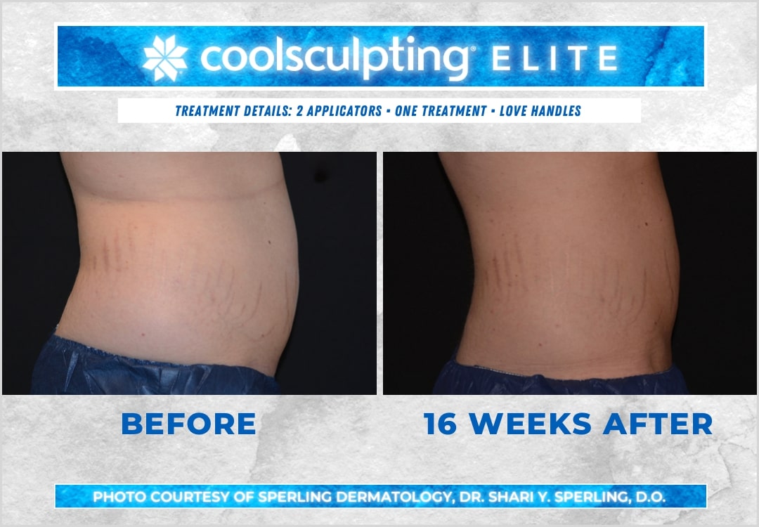 Before & After Love Handles CoolSculpting in New Jersey