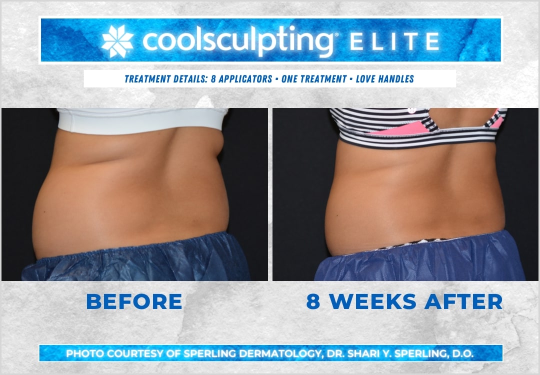 Before & After Love Handles CoolSculpting in New Jersey